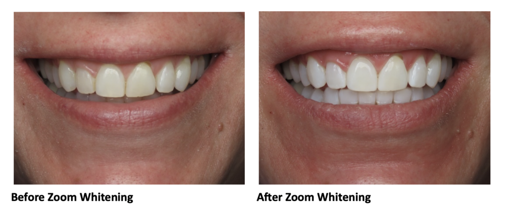 Before and After Zoom Whitening